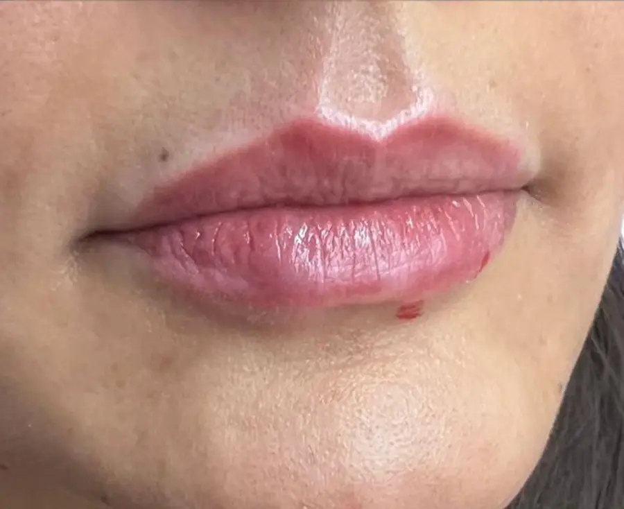 Labios después del ácido hialurónico — resultado natural