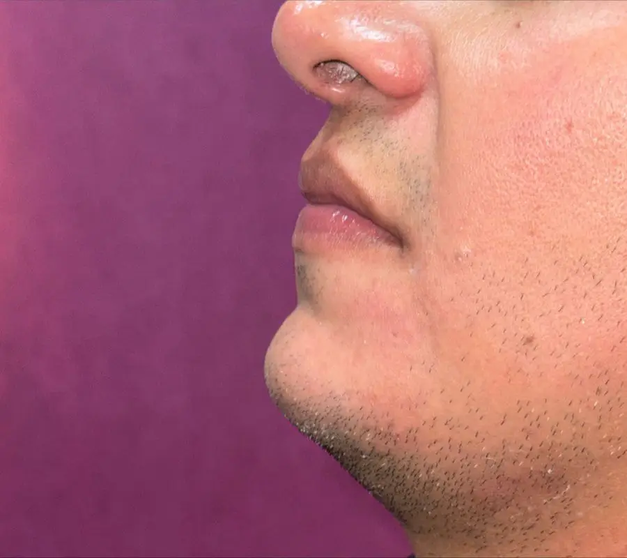 Perfil facial con mentón y mandíbula definidos